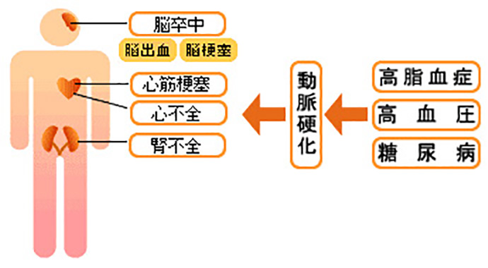 脳卒中になるメカニズム